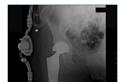 bari radiografica con protesi post intervento